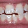 Lower Chipped Tooth Before